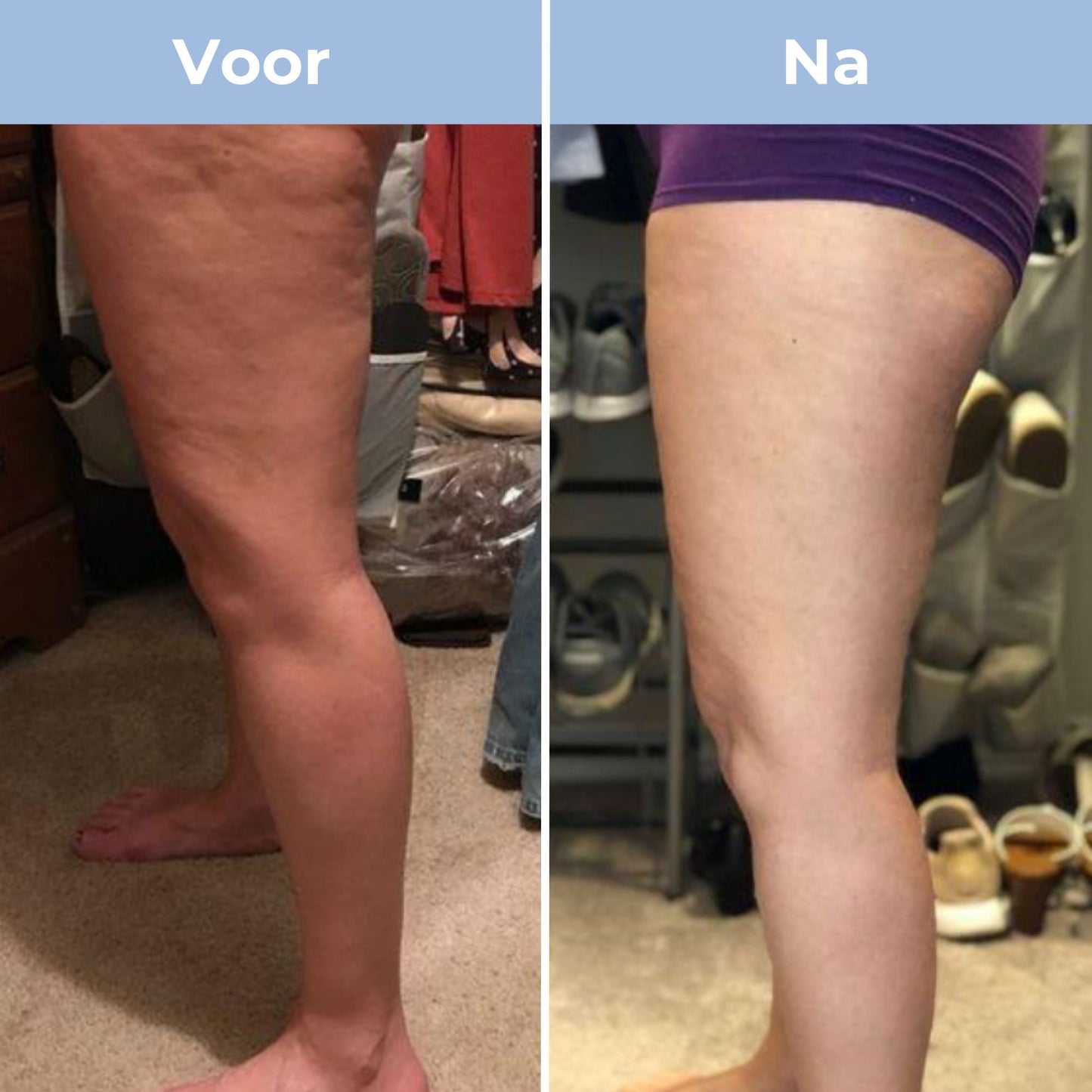 CelluFit Therapie Pro - Cellulitis Massager