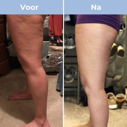 CelluFit Therapie Pro - Cellulitis Massager