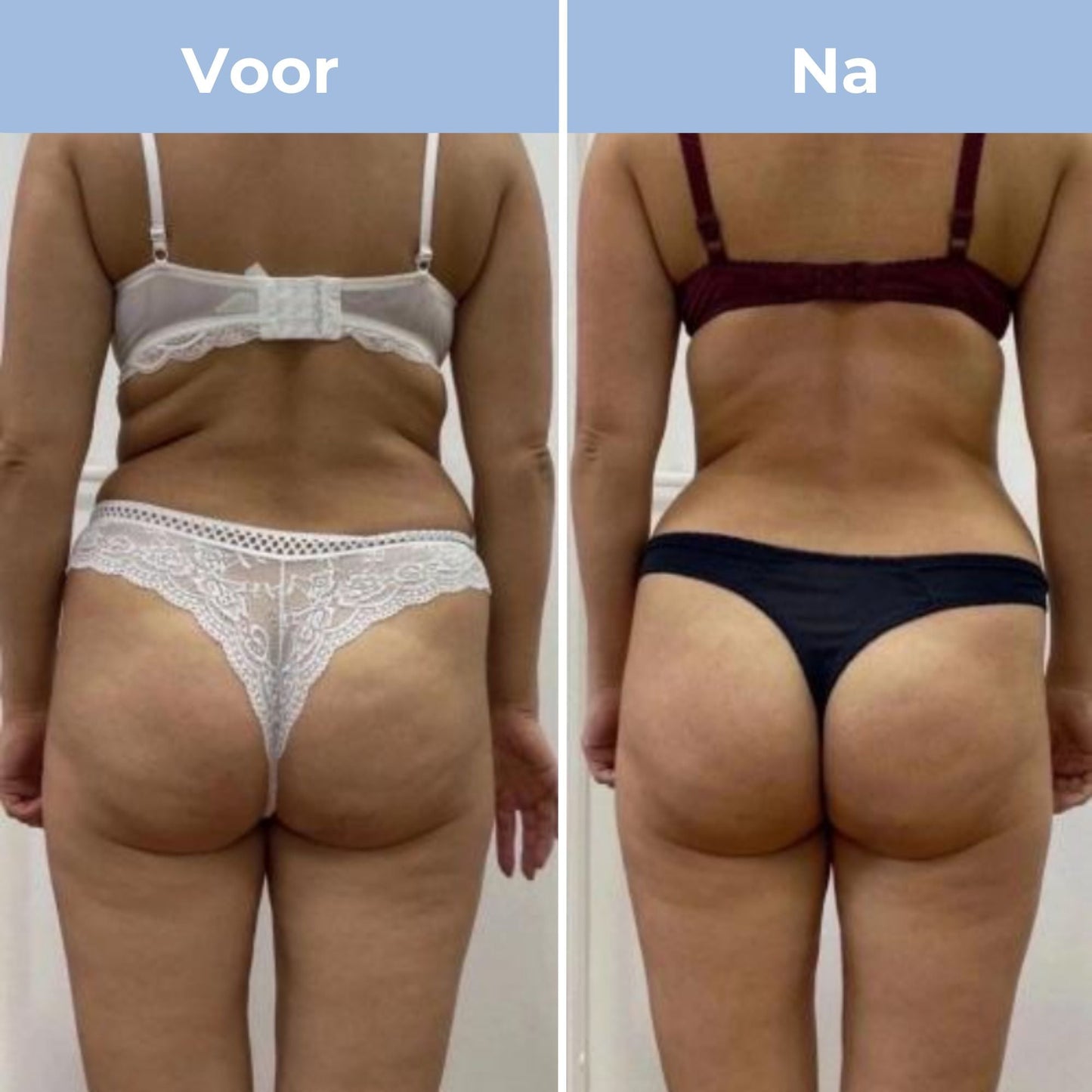 CelluFit Therapie Pro - Cellulitis Massager