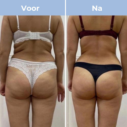 CelluFit Therapie Pro - Cellulitis Massager